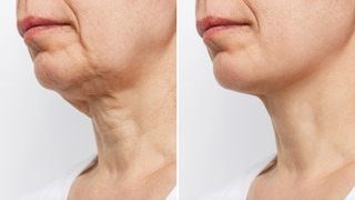 The Best Ways to Naturally Lift Your Face Without Surgery