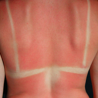 SPF, UVB, and UVA: Why Sunscreen is So Important
