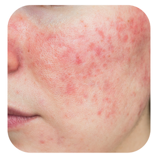 Rosacea + Hyperpigmentation