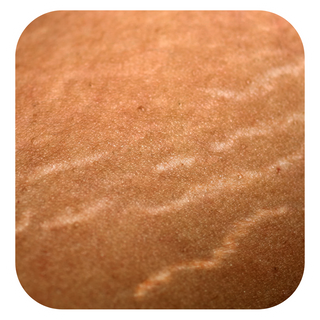 Stretch Marks + Cellulite