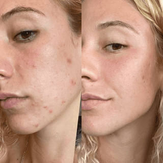 Natural 2.5% Retinol Serum (Anti-Aging) - Wrinkles, Acne, Pores