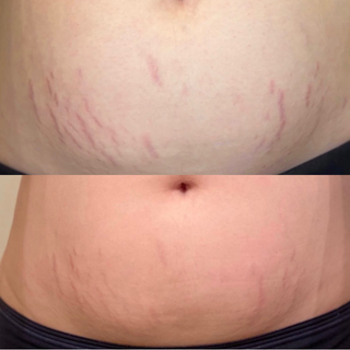 Body Dermaroller Head (3 PACK) - Stretch Marks, Cellulite