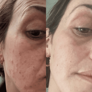10% Vitamin C + Squalane Repair Cream - Hyperpigmentation, Acne, Wrinkles