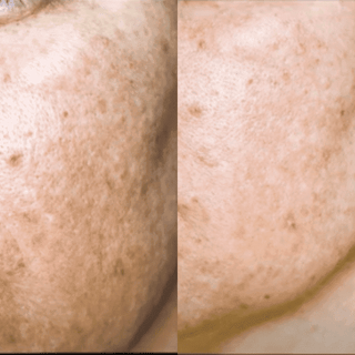 Advanced Complete Dermaroller Kit - Deep Wrinkles, Scars
