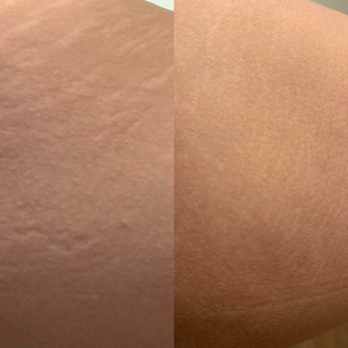 1.0mm Body Dermaroller Head Replacement - Stretch Marks, Cellulite