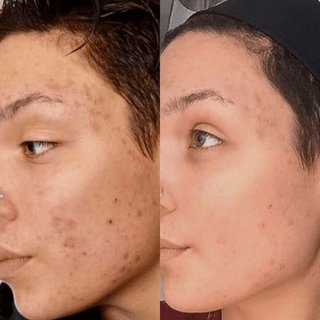 Natural 20% Vitamin C Booster (Brightening) - Scars, Hyperpigmentation, Wrinkles