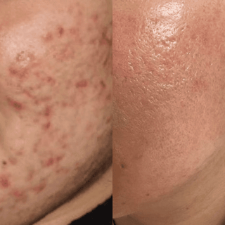 Repair Kit - Acne Scars, Oily Skin