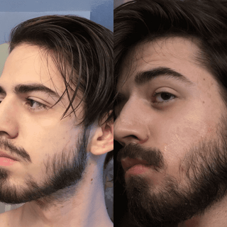 0.75mm Dermaroller (Real Individual Needles®) - Wrinkles, Hair Growth, Male Beard Growth