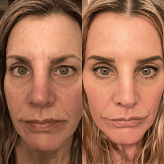 Natural 2.5% Retinol Serum (Anti-Aging) - Wrinkles, Acne, Pores