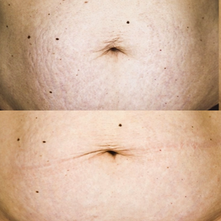 1.0mm Body Dermaroller Head Replacement - Stretch Marks, Cellulite
