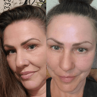 Dermaroller Starter Kit - Wrinkles, Hyperpigmentation