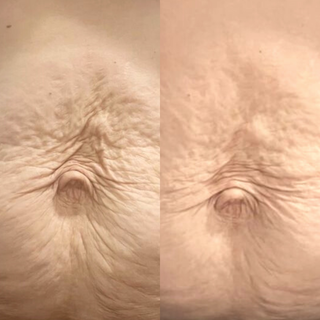 1.5mm Body Dermaroller Head Replacement - Stretch Marks, Cellulite