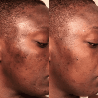 Natural 20% Vitamin C Booster (Brightening) - Scars, Hyperpigmentation, Wrinkles