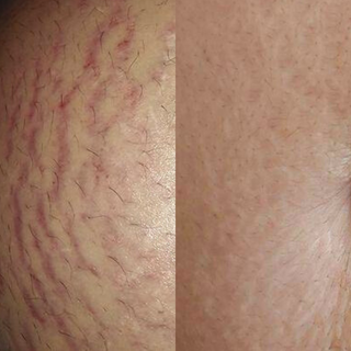 1.5mm Body Dermaroller Head Replacement - Stretch Marks, Cellulite