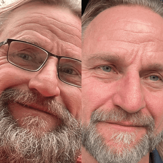 0.75mm Dermaroller (Real Individual Needles®) - Wrinkles, Hair Growth, Male Beard Growth
