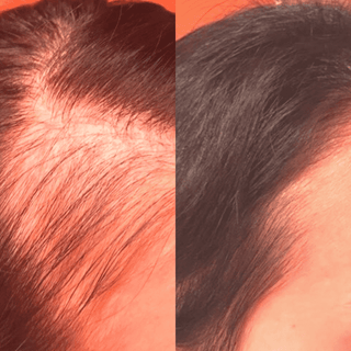 1.0mm Dermaroller (Real Individual Needles®) - Deep Acne Scars, Saggy Skin, Hair Growth