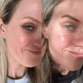 0.5mm Dermaroller (Real Individual Needles®) - Wrinkles, Hyperpigmentation