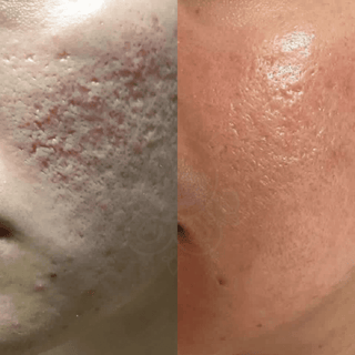 1.0mm Dermaroller (Real Individual Needles®) - Deep Acne Scars, Saggy Skin, Hair Growth