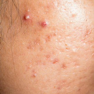 5 Ways to Stop Acne In Its Tracks