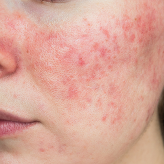How I Naturally Cured My Rosacea