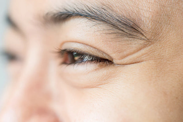 How To Get Rid Of Crow's Feet Without Fillers?