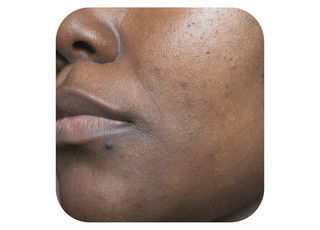 Acne Scars + Texture