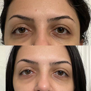 Eye Care Kit - Crow's Feet, Dark Circles, Eyebags