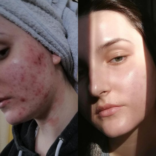 Anti-Acne Kit - Pimples, Blackheads, Whiteheads