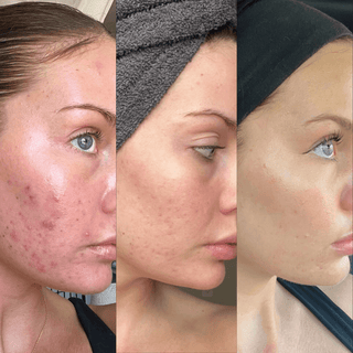 10% Vitamin C + Squalane Repair Cream (3 PACK) - Hyperpigmentation, Acne, Wrinkles