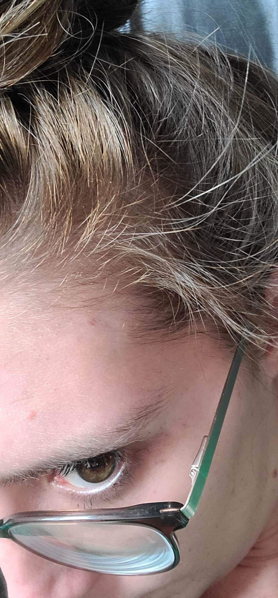 <strong>4. Scalp inflammation is silently killing your follicles , and you can't see it.</strong>