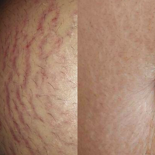 Stretch Marks Kit - Stretch Marks, Cellulite, Scars