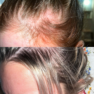 Hair Growth Kit - Hair Loss, Damage, Beard Growth