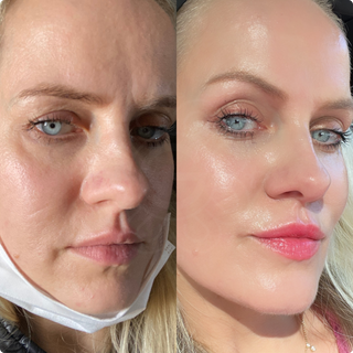 4 in 1 Dermaroller Bundle - Wrinkles, Hyperpigmentation, Scars